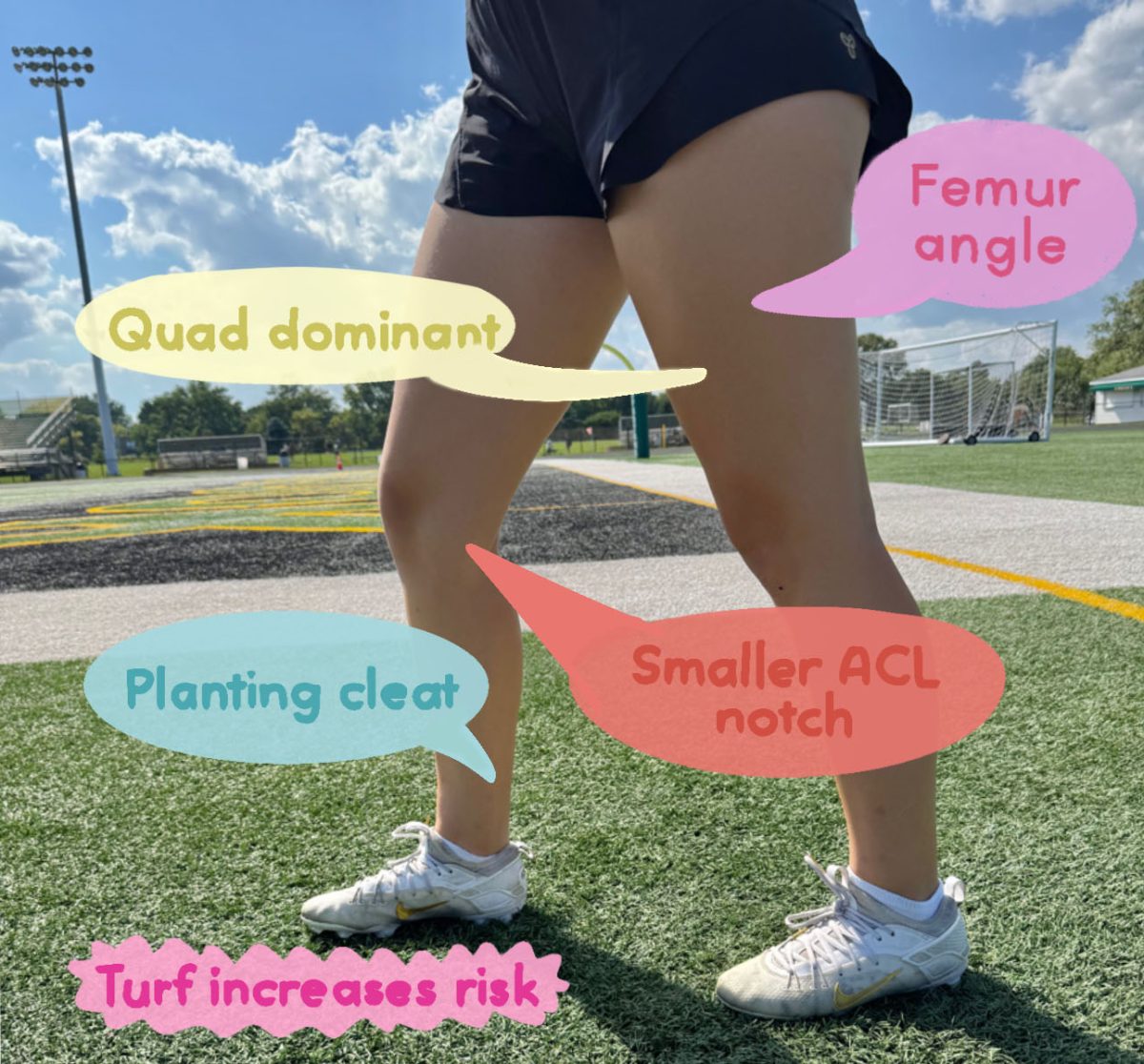Women are more susceptible to ACL tears because they have an angled femur, a smaller ACL notch and are more quad dominant.
Graphic by Vivien Brennan